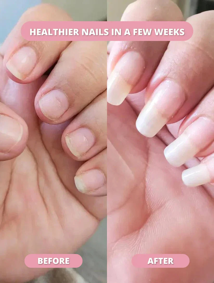Nail Growth Pen™